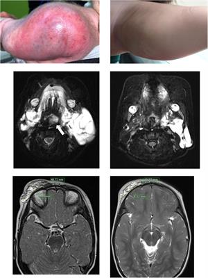Clinical effectiveness and safety of sirolimus in pediatric patients with complex vascular anomalies: necessitating personalized and comprehensive approaches